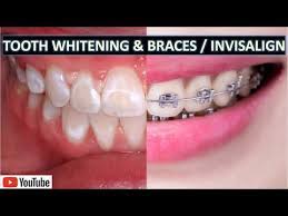 Are you wondering how to whiten your teeth with braces? Professional Teeth Whitening With Braces Invisalign Youtube