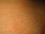 Does Laser Hair Removal Hurt
