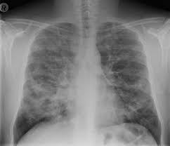 Viva Practice Chest X Ray Radiopaedia Org X Ray Practice Chest