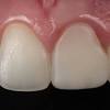 Dec 09, 2019 · many experts today believe that eating softer foods, especially as children, plays a role in impacted wisdom teeth. 1