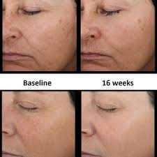 PDF) Efficacy of Topical Hydroxypinacolone Retinoate‐Peptide Product Versus  Fractional CO2 Laser in Facial Aging