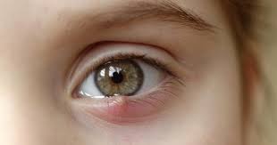 How To Get Rid Of A Stye: 17 Home Remedies And Treatments