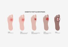 Image result for Wagner Ulcer Classification