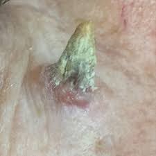 Image result for cornu cutaneum)