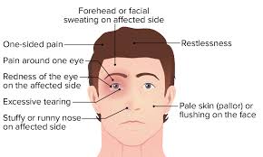 Image result for Cluster Headache