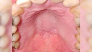Image result for Mouth ulcers symptoms roof of the mouth