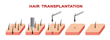 Harley street hair clinic provide bespoke treatments. How Much Does It Cost To Get Hair Transplant In India Quora