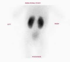 Dmsa 0.25mg without vit c (lowest dosage). Dmsa Scan Infokid