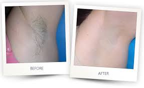 Also how long does the hair removal process last, get important laser hair removal facts? How Does Laser Hair Removal Work Fort Lauderdale Laser Hair Removal Baltic Beauty Centre