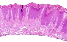 Image result for Lichen Simplex Chronicus