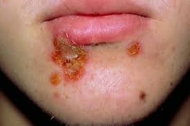 Image result for yellow scabs on the face in children