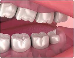 Maybe you would like to learn more about one of these? Wisdom Teeth Removal
