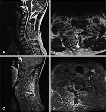 Le ligamentum flavum (lf) a été peu étudié alors qu'il est très particulier. Thickening Ligamentum Flavum Mimicking Tumor In The Epidural Space Of The Cervical Spine Abstract Europe Pmc