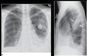 The pleura are thin membranes that line the lungs and the inside of the chest cavity and act to lubricate and facilitate breathing. Pleural Effusion Flashcards Quizlet
