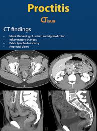 Image result for Proctitis