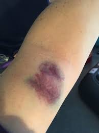 Bruising can also develop after the rupture of the pierced vein, in which case, a small hole opens up and blood starts leaking through it. Anyone Else Bruise After Blood Draw Babycenter