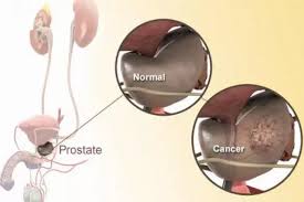 Image result for Prostate Cancer