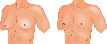 Because every woman's cancer is different, the symptoms, treatment and prognosis varies from one person to another. Gynecomastia Healthdirect