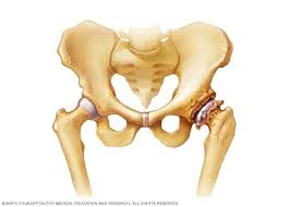 This form of cancer can only be detected using chondrosarcoma is most commonly found in the bones of the hips and pelvis. Bone Spurs Symptoms And Causes Mayo Clinic