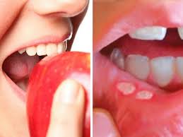 Ketua jabatan bedah mulut dan maksilofasial, hospital kuala lumpur (hkl), dr sivakama sunthari, berkata ulser atau pecahan pada rongga mulut tidak sembuh lebih dua minggu perlu dirawat bagi. Mulut Sakit Buat Aktiviti Harian Anda Terganggu Ini Cara Paling Simple Nak Hilangkan Ulser Maskulin