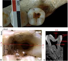 Weight loss or nutrition problems from painful or difficult eating or chewing 3. Earliest Evidence Of Dental Caries Manipulation In The Late Upper Palaeolithic Scientific Reports