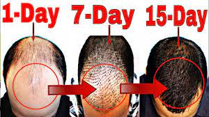 It makes your hair healthier and reduces breakage of hair. How To Stop Hair Fall Naturally Grow Hair Faster Men Women Youtube