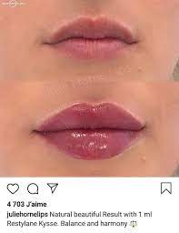 Pin By Dina Magdy On Lip Fillers Lip Fillers Facial Fillers Lip Fillers Juvederm