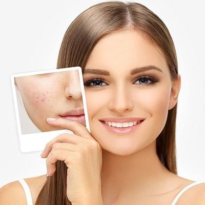 Laser Acne Treatment in Islamabad-Rawalpindi & Pakistan
