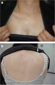 Poland syndrome is a congenital absence of the pectoralis major muscle, usually the sternal component, as well as breast and areolar hypoplasia. Poland Syndrome Causes Symptoms Diagnosis Treatment Prognosis