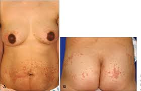 Image result for pruritic urticarial papules and plaques of pregnancy