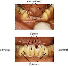 19 Conventional Bridges Pocket Dentistry