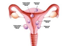The vast majority of fibroids are benign although one very rare type of uterine fibroid, known as leiomyosarcoma, is cancerous. Fibroids Nhs