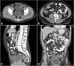 Some common symptoms of peritoneal mesothelioma are abdominal pain, abdominal swelling, weight loss, fever, fluid in peritoneal cavity, intestinal obstruction, night sweats and hypercoagulability. Scielo Brasil Benign Multicystic Peritoneal Mesothelioma Literature Review And Update Benign Multicystic Peritoneal Mesothelioma Literature Review And Update