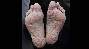 Athlete's foot is contagious and can be. Trench Foot Symptoms Causes Pictures And Treatment