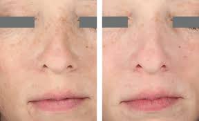 Cover Story: Candela's Revolution in Radiofrequency Microneedling