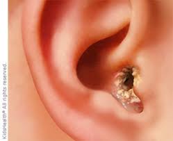 Signs of an ear infection include fussiness, tugging at the ear, fever, and a loss of appetite. Swimmer S Ear Otitis Externa For Parents Nemours Kidshealth
