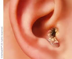 If you are a parent trying to keep your baby from dunking their heads in the bath water to avoid their umpteenth ear infection before the age of two, then you might be getting frustrated with your baby's tendency to pour water on her head or lay back in the water with their ears submerged. Swimmer S Ear Otitis Externa For Parents Nemours Kidshealth