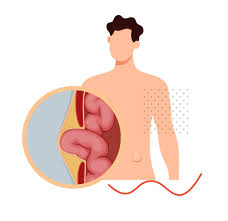 Image result for stomach hernia symptoms