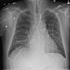 Maybe you would like to learn more about one of these? Chest X Ray Of A Patient With History Of Pleural Effusion Bmj Case Reports