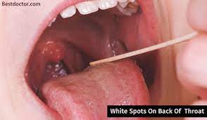 Several types of infections may cause white spots on your throat. White Spots On Back Of Throat Causes And Tips To Prevent