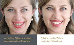 Weiße zähne in nur einer sitzung mit zahnbleaching. Zahnbleaching In Bad Honnef Bei Bonn Bleaching Fur Zahne