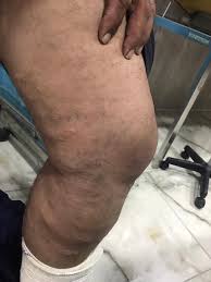 دوالي الساقين الصورة قبل العملية وبعده عيادة الدكتور زياد ياسين الخزرجي Facebook
