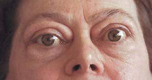 It is seen in both dogs and cats and, depending on the underlying cause, affects animals of different ages. Schilddruse Hyper Und Hypothyreose Klinik Via Medici