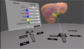 Liver 3d models ready to view, buy, and download for free. Using Virtual 3d Models In Surgical Planning Workflow Of An Immersive Virtual Reality Application In Liver Surgery Springerlink