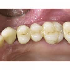 Eifrig wurden die verschiedenen lebensmittel in „gut oder „schlecht eingeteilt. Fullungen Und Inlays Unsere Leistungen Sagadent Zahnarzt Munchen