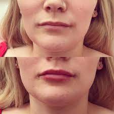 We did not find results for: Gd Aesthetics Before And After 1ml Juvederm Over Half Of The Syringe Was Added To My Clients Bottom Lip To Add More Volume To It The Rest Of The Syringe