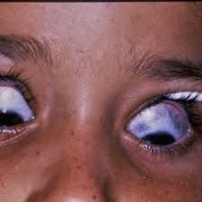 Image result for melanosis sclera