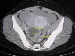 Picture of ovarian cyst