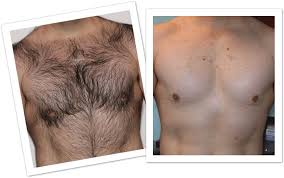 Laser floater removal (vitreolysis) at boston eye group. Laser Hair Removal Boston Ma Salem Laser Hair Removal