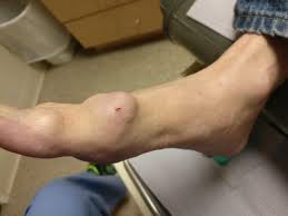 The most common bone spur on the side of the foot is a bunion which is an enlargement of bone just behind the big toe. The Bone Spur On Top Of Foot Causes Symptoms Best Treatment